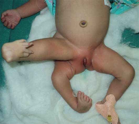 A parasitic lower limb arising from the anterolateral aspect of the right inguinal region.